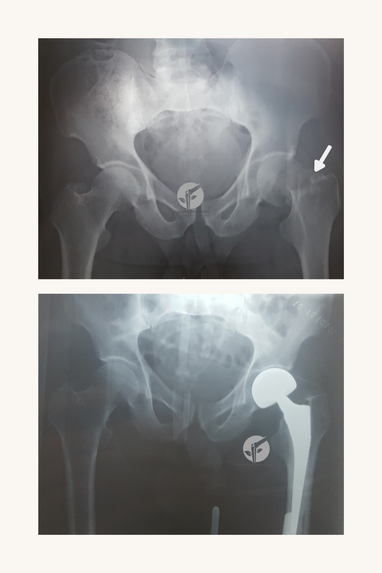 Prothèse intermédiaire pour fracture du col du fémur par Dr. Bachiri Mohammed à Oujda